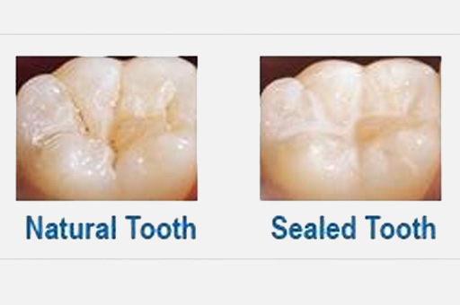 Natural tooth and Sealed Tooth image for Pit and fissure sealants